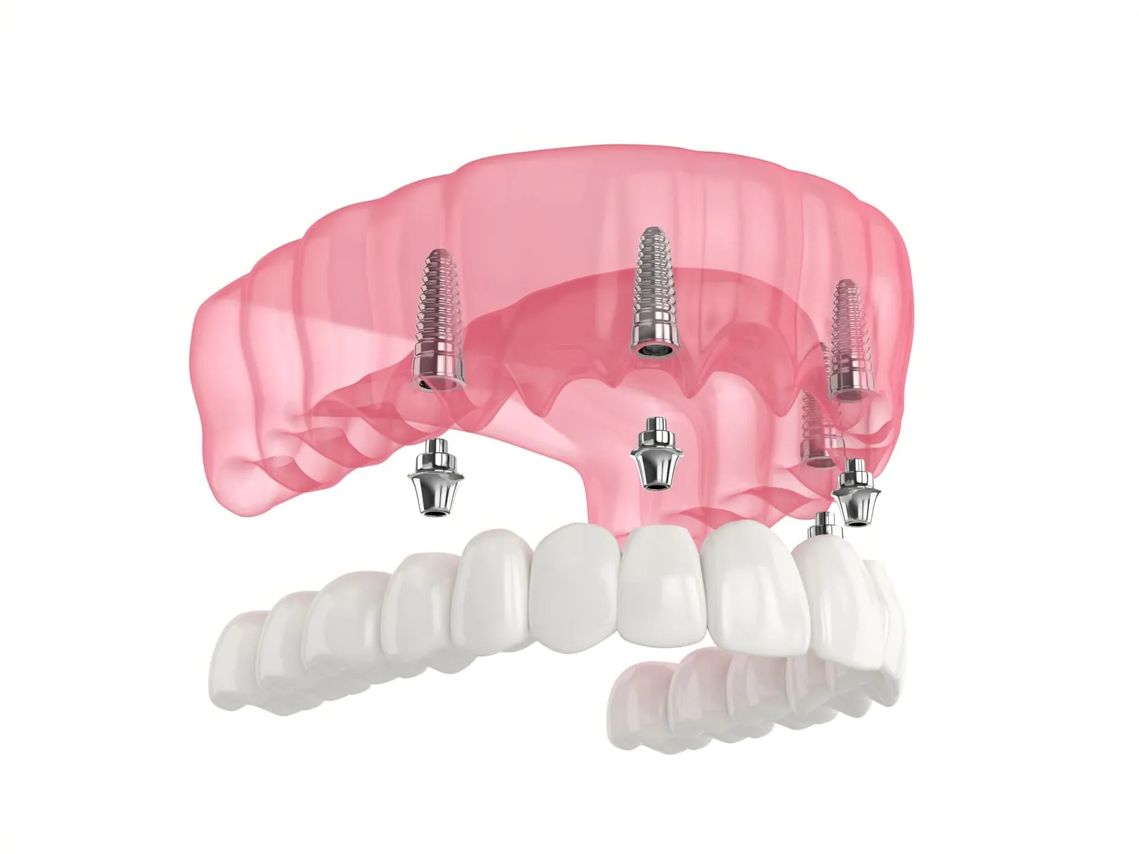 Transform Your Smile with All-on-4 Dental Implants in Fort Collins